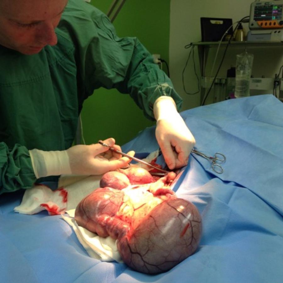 The huge uterus being removed in surgery