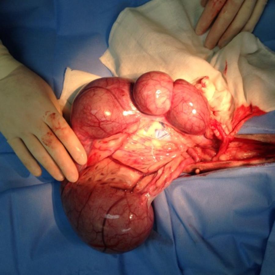 The uterus with infection