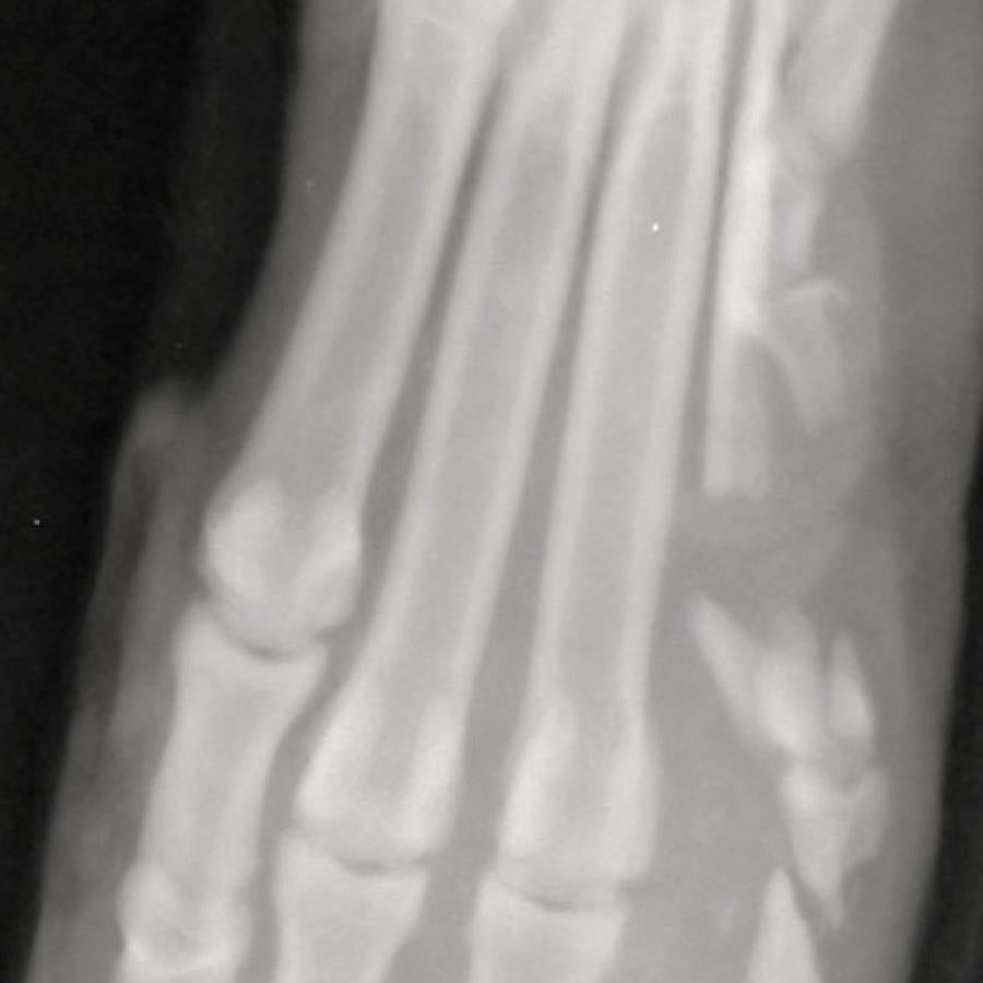 xray of the foot with missing bone