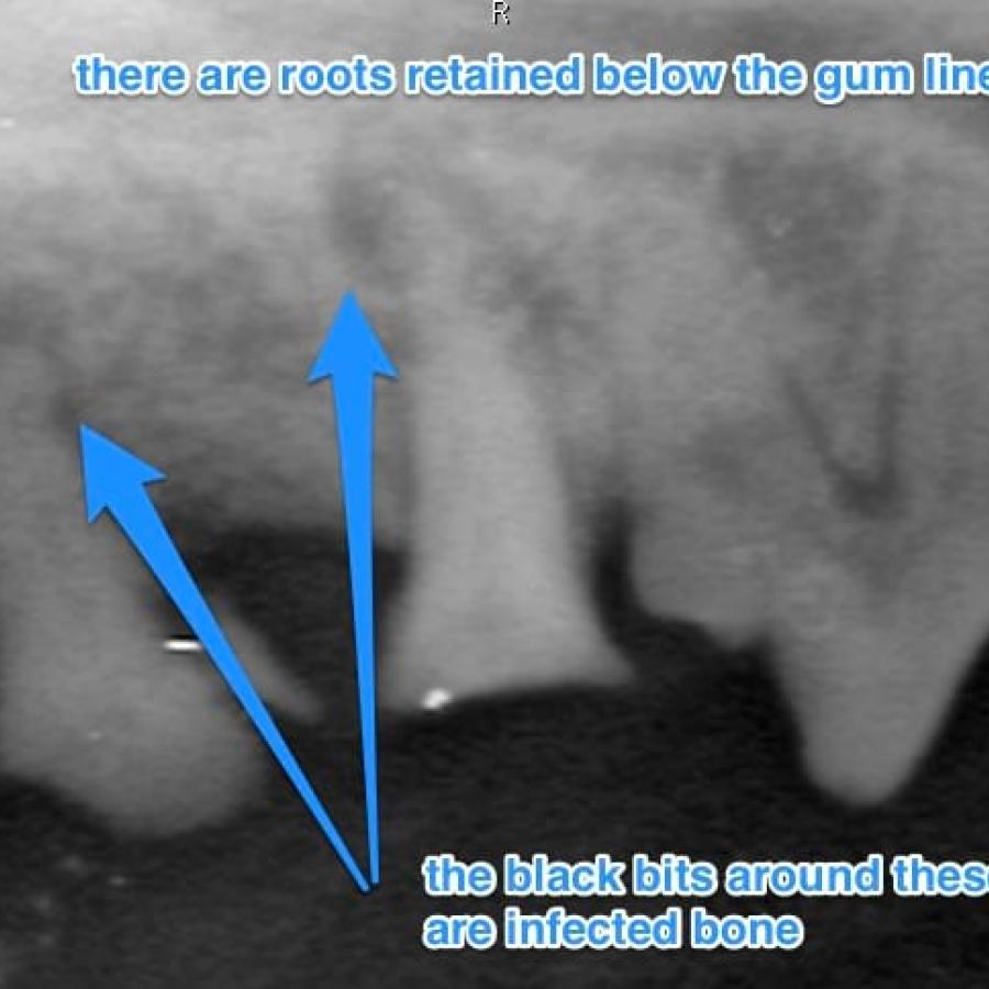 retained roots visible on xray